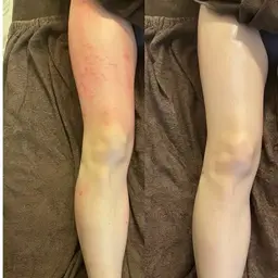 最強セル脂肪ケア♥️【大人気】スライドカッピング痩身 60分💥✨