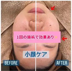 💫小顔コース💫 美顔器で即むくみ解消✨️EMSでリフトアップ効果も✊🏻小顔/たるみ/むくみ/毛穴/フェイシャル