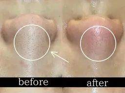 【毛穴洗浄】ハイドラフェイシャル全顔+首