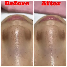 リピーターさま✨顔全体毛穴洗浄とピールオフパック付き☺️まずは土台作りから美肌へのステップ