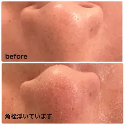 午後1枠本日限定！【黒ずみ毛穴洗浄×全顔導入付き】角栓ポップアップ洗浄！◎黒ずみ◎ざらつき◎ツルツル肌、1回で効果実感