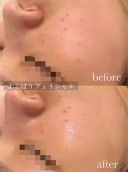 毛穴洗浄＋国産ハーブピーリングのよくばりフェイシャル/お肌をどうにかしたい方、メニューに迷った方はまずコレ！