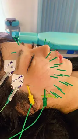 【左右差/ゆがみに】骨盤整体つき小顔美容鍼70分