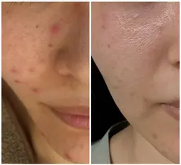 【ニキビ・ニキビ跡/毛穴】幹細胞&ハーブピーリング🌿つるんとなめらか肌へ✨敏感肌でも◎