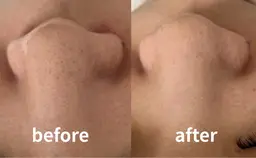 【ミニモ限定/フェイシャルモニター様募集】毛穴の黒ずみリセットコース/毛穴洗浄