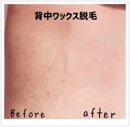 🟣WAX脱毛🟣ブライダルプラン【背中(上)+うなじ+腕(上)+デコルテ】3カ所選択☆1回でOK！挙式日5​〜​7日前迄！