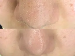 【福袋B】毛穴/黒ずみ/角質◎オーダーメイド毛穴洗浄3回券★通常→¥17,180