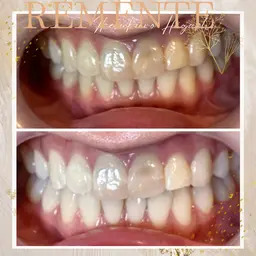 【今月限定！】リピート率95%◎魔法のホワイトニング30分◆¥10000→¥4000