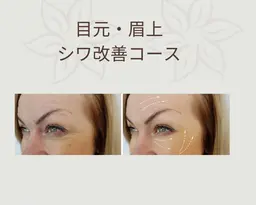 【整体フェイシャル】　目元/眉上　シワ緩和コース