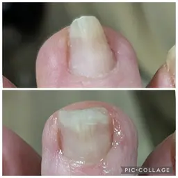 巻き爪補正(1本)