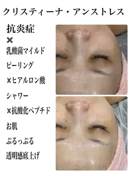 肌質を自分史上最強の理想状態に🩵クリスティーナ2種/72時間スキンインプラントEXOMERE/IPL光フェイシャル🩵
