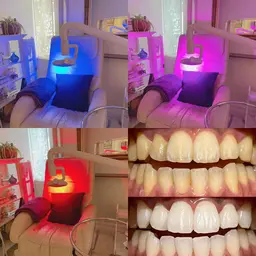 歯のセルフホワイトニングずーっと3980円