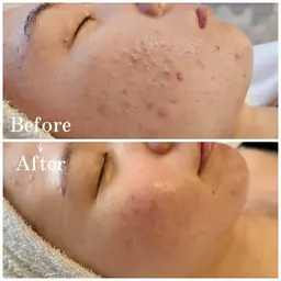 人気NO1 肌再生HAAB REPROハーブピーリング