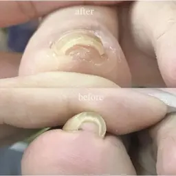 🔴フット🔴巻き爪ケア