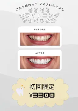 【医療用薬剤使用！】セルフホワイトニング　初回３３００円