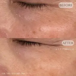 【シミケア】-低周波シミケアで肌負担なくシミにアプローチ！戻りジミのリスクなし✨シミケア20分までし放題