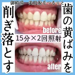 当日予約🆗セルフホワイトニング🦷✨約45分でトーンアップ‼️
