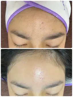 人気の脱毛メニュー🤎【白玉フェイシャルwax✖️光脱毛🎅】脱ニキビ❣️