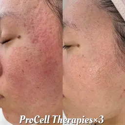 肌質改善(毛穴・シミ・シワ・たるみ・クレーターなど)