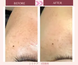 当て放題で本気のシミケア！３回限定モニター✨