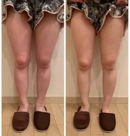 【キャビテーション】脚痩せコース🦵✨