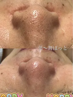 毛穴黒ずみ、つまりを爽快にリフレッシュ　毛穴エクストラクション＆シュガーリング脱毛スキンケア＆プルプル肌パック