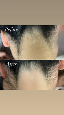 【女性全員】期間限定🌟うなじワックス＆うなじ光脱毛