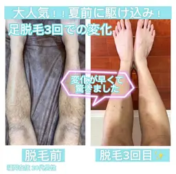 🔹メンズ脱毛🔹足を出す季節🏝️ プロによる脱毛で自己処理しない夏を過ごしませんか？　しっかり３回コース