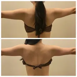 【初回】背中美人を目指して🩵スタイルアップの印象を💃背中&二の腕痩せ【最新痩身機器】