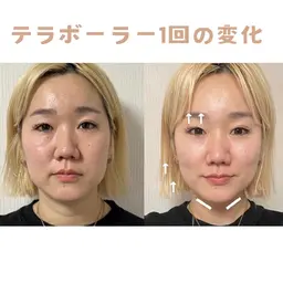 たるみむくみ改善【ぎゅーんと頬肉持ち上げる】テラボーラー体験