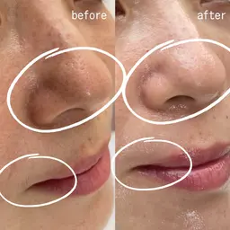 フェイスワックス！美肌爆弾HARIパック付き✨フェイスワックスでしか手に入らないツルツル素肌を体感してくださいませ🤭