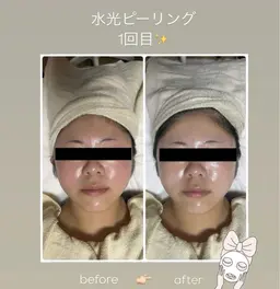 剥離なし❣️渡韓なし❣️韓国肌ケア人気No.1✨【水光ピーリング】➕ヘッド➕デコルテマッサージ付き💆🏻‍♀️