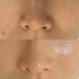 毛穴レス&ツヤ肌爆弾ピーリング