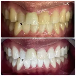 ✨一番人気✨【🔥圧倒的効果🔥】通常の倍照射！セルフホワイトニング8,800円🦷✨