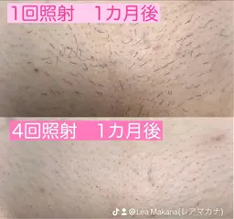 初回限定【VIO脱毛】カウンセリング込◎ニオイ、蒸れからの解放◎ストレスフリーな生活へ✨介護脱毛をお考えの方