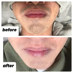 ヒゲ脱毛3回10000円‼️