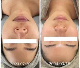 【毛穴のプツプツ詰まり・ベタつき改善】ハーブピーリング＋生酵素 ¥15,400→¥9,900