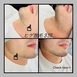 🚹限定❗️脱毛士による丁寧なヒゲ脱毛🥼他店で抜けなかった方、初めてで分からない方、丁寧なカウンセリング込みです🤓