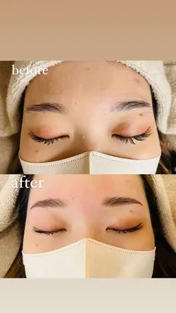 ハリウッドブロウリフト