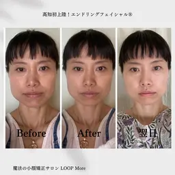 お1人さま1回限り！魔法の小顔矯正【エンドリングフェイシャル】モデルさん募集★ 12000円→3500円