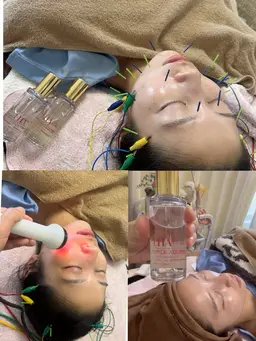 👰‍♀️ブライダルにも人気【爆艶ララピール✖️引き上げ美容鍼】美容液導入＋高周波付き強力emsで更なる引き上げ