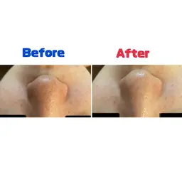 【ウィンバックフェイシャル】⭐️30代以降にオススメ⭐️ハリ・しわ・たるみ・小顔