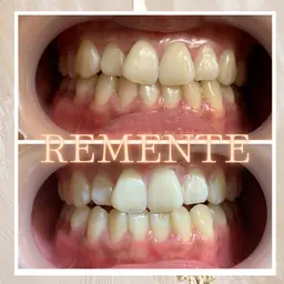 【当日予約限定！】リピート率95%◎魔法のホワイトニング30分◆¥10000→¥2980