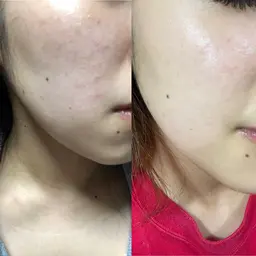 モニター価格　赤みケア