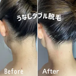 🌹ミニモ予約率No.1🌹うなじダブル脱毛(WAX＋高速光脱毛)【目指せうなじ美人✨🤍】◎口コミ必須