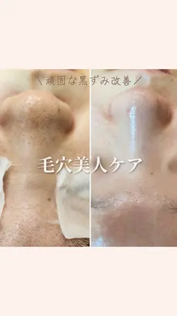 3月限定✨毛穴の黒ずみモニター新規限定✨スピード毛穴洗浄（毛穴エクストラクション）