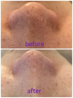 【サロン人気NO1】メニュー！！毛穴の汚れ撃退コース！！