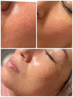 極上美肌リセットコース