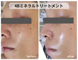 4Bミネラルトリートメント(ハーブピーリング)
