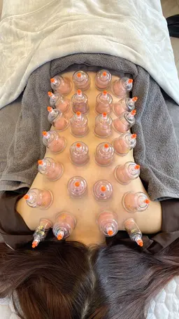 🌟むくみ撃退👋🏻定番の吸い玉‼️足と背中すっきりカッピング😌🌿